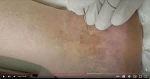 Ankle Sprain