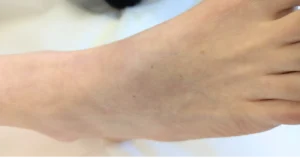 Acupuncture for ganglion cyst