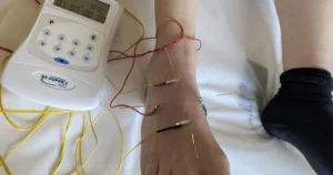 Acupuncture for ganglion cyst