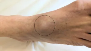 Acupuncture for ganglion cyst