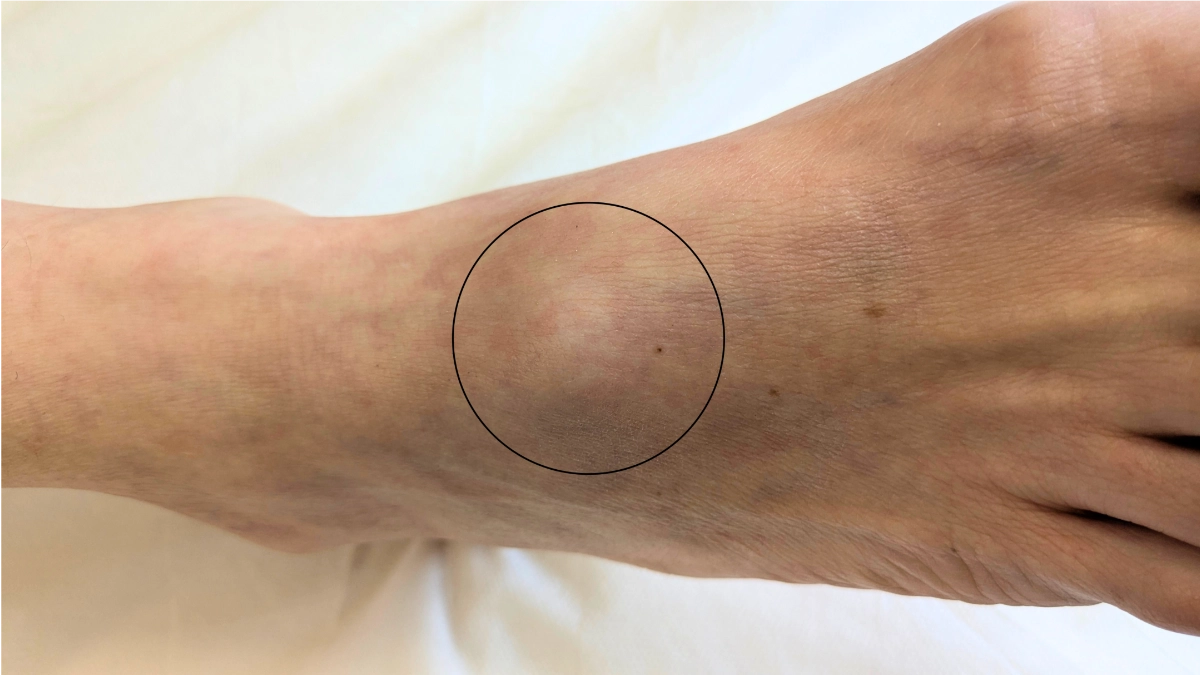 Acupuncture for ganglion cyst