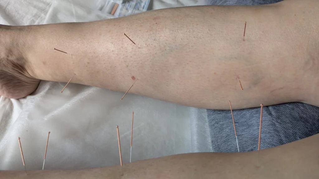 Master Tung Points: Three Lower Emperors and Kidney Channel