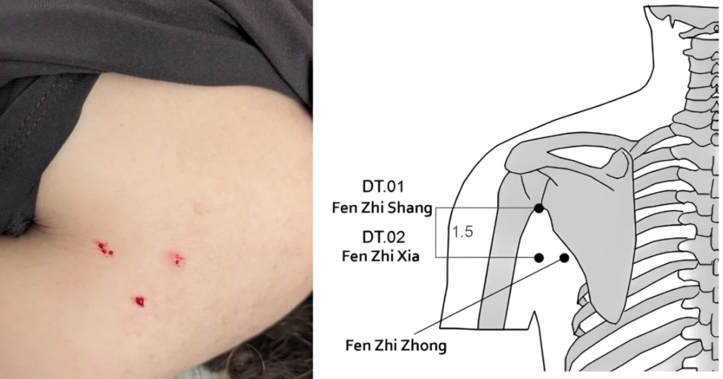 Master Tung's 32 Relieving Points
