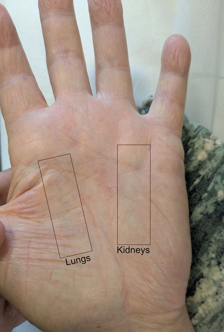 Palmistry diagnosis Enhanced photograph of the patient's left palm showing congested vessels in the Kidney and Lung zones
The patient's left palm, photographed at our most recent session. Contrast has been digitally enhanced to make the surface vasculature legible in a clinical photograph; the vascular pattern itself is unaltered.