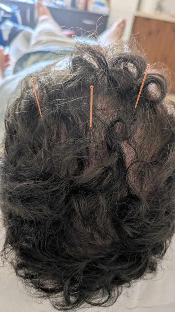 Chronic Post-Traumatic Headache Scalp acupuncture was applied directly along the affected arc of the head.